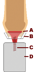 foreskin restoration weight device